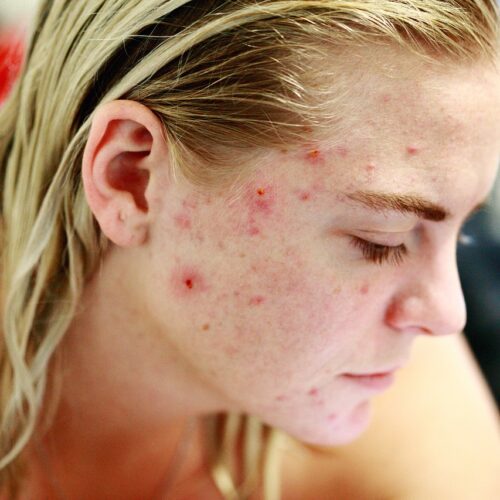 struggle, acne, self love